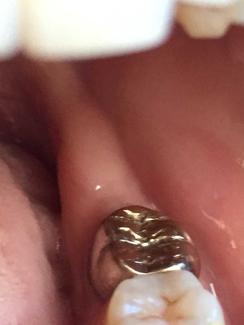 装了个贵金属牙冠,看上去是银色的.是假的吗?