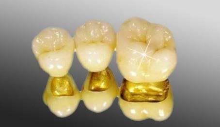 贵金属烤瓷牙的特点